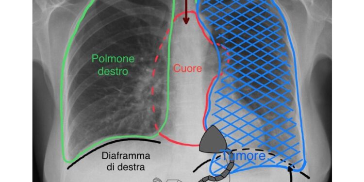 La massa di venti centimetri al timo comprimeva anche un polmone